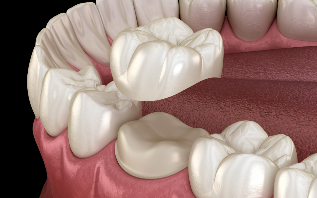 dental crown 3d model