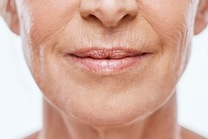 botox