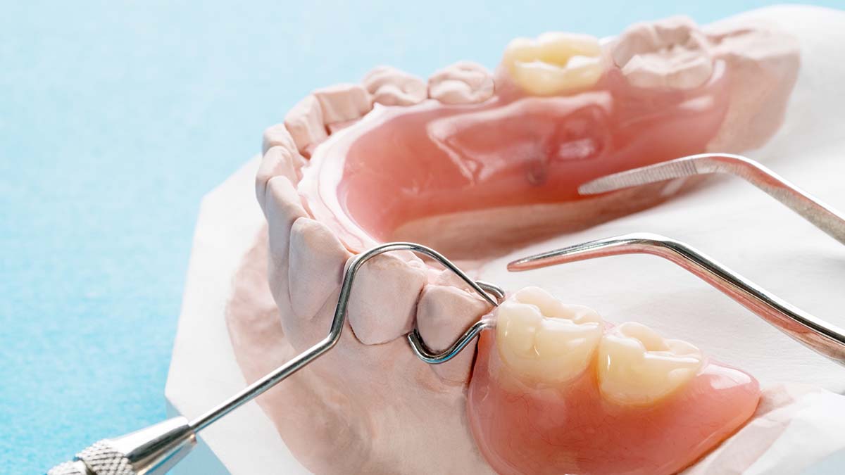 Implant-Supported Dentures vs Traditional Dentures
