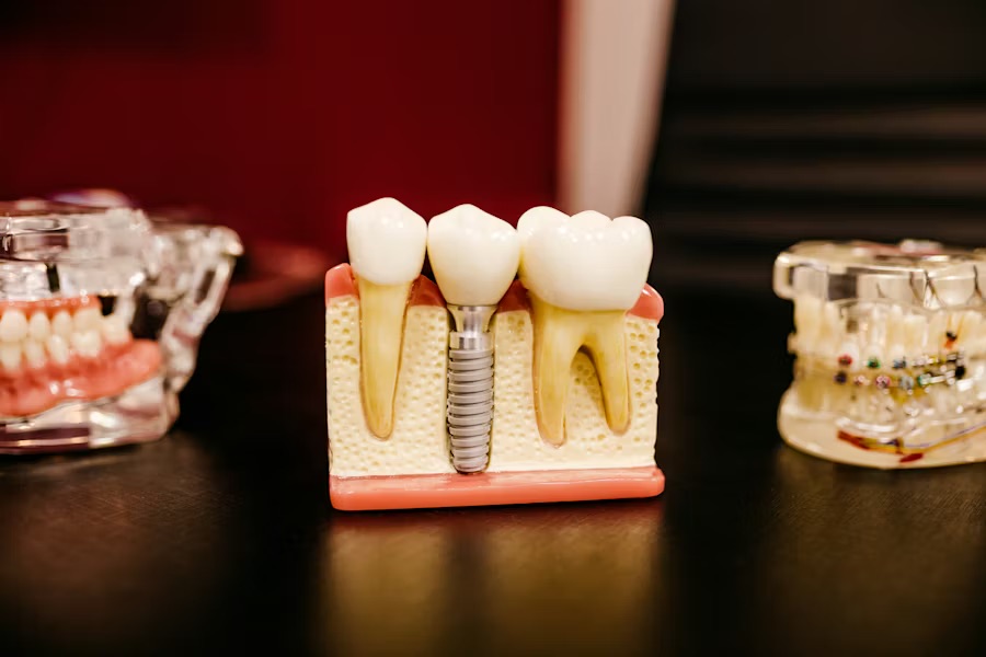 root canal vs dental implant Richmond VA